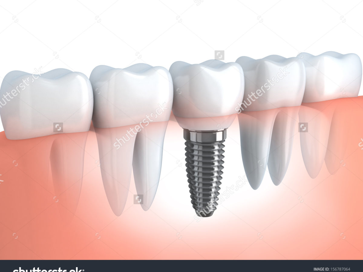 Dental Implants - Do Teeth Dictate the Type of Implants?
