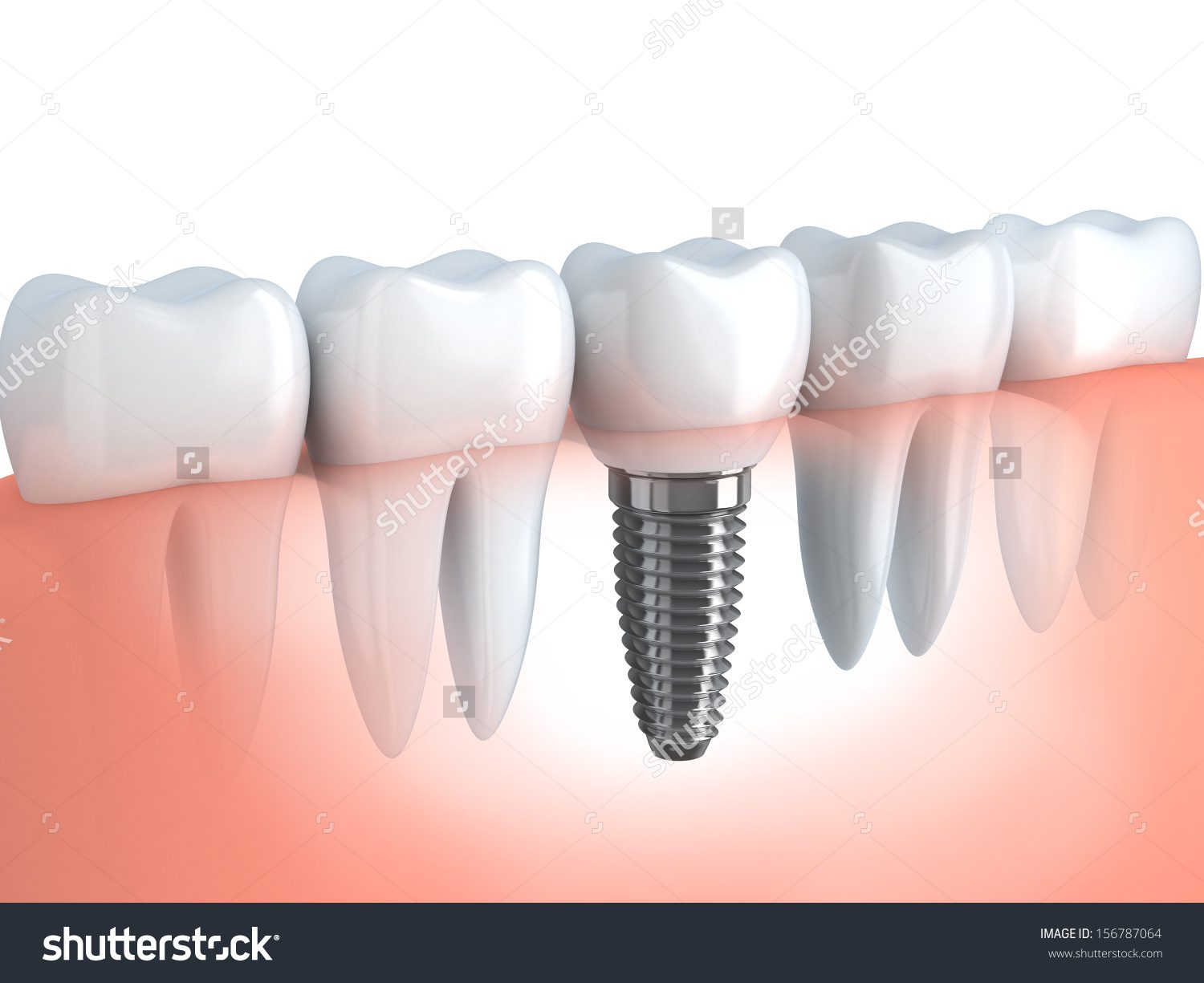 Teeth canine Types of