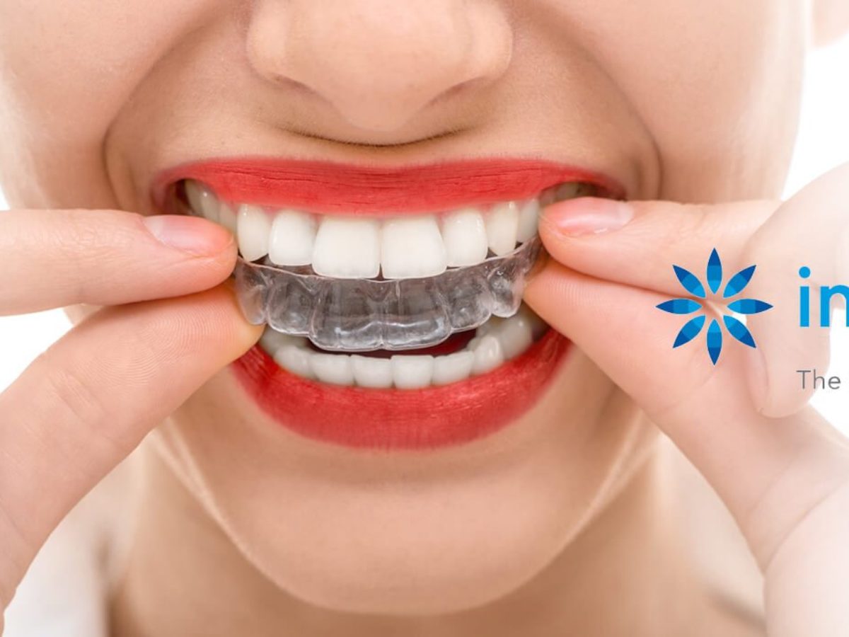 Braces vs. Invisalign: A Visual Guide to Your Orthodontic Treatment Options