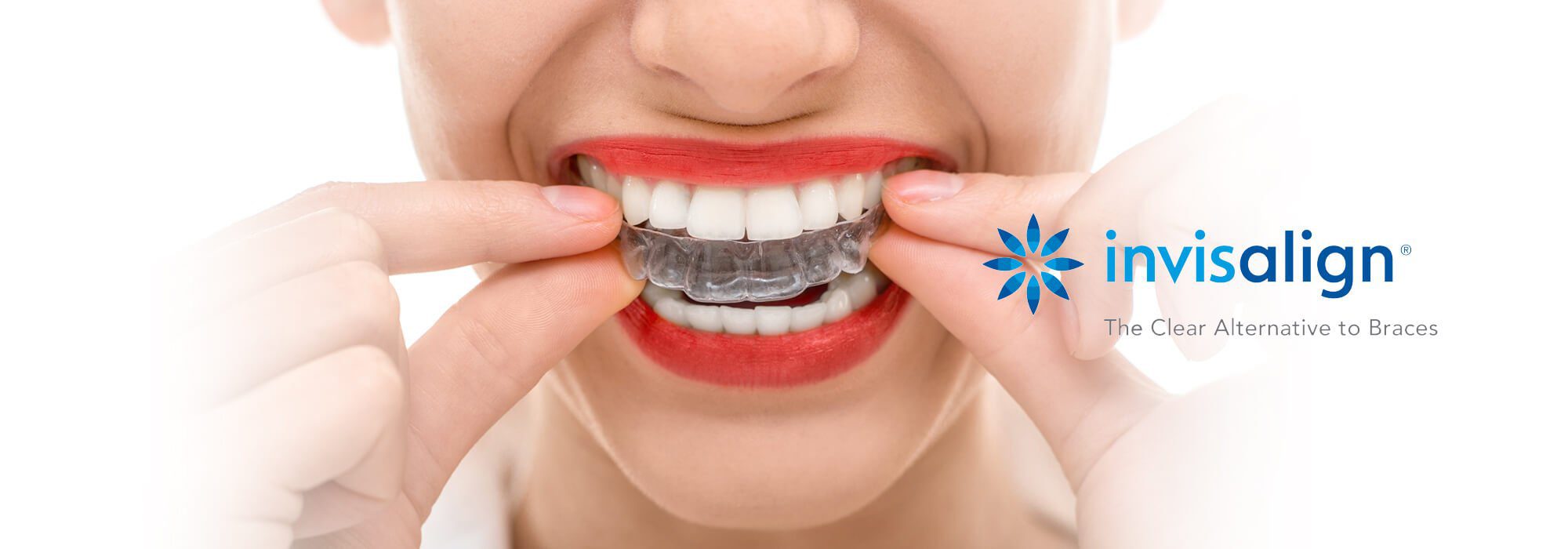 Metal Braces Work Faster Than Clear Aligners: Find Out Here!