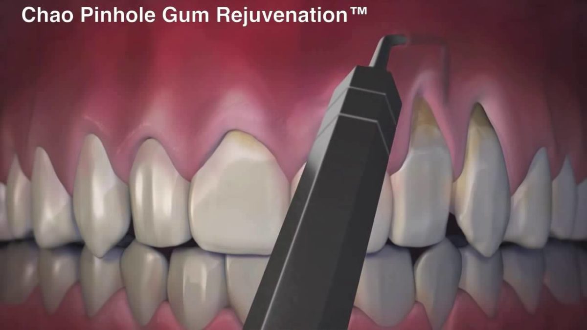 Pinhole Surgery - Gum Rejuvenation - Barrie Ontario