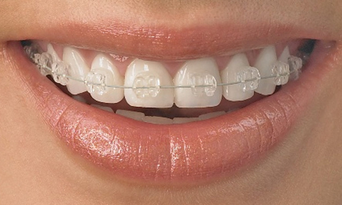 Clear Invisible Braces for Adults to Straighten Teeth