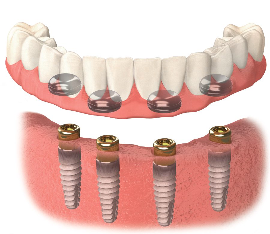 Understanding Denture Locator Implants and How They Work | Georgian ...