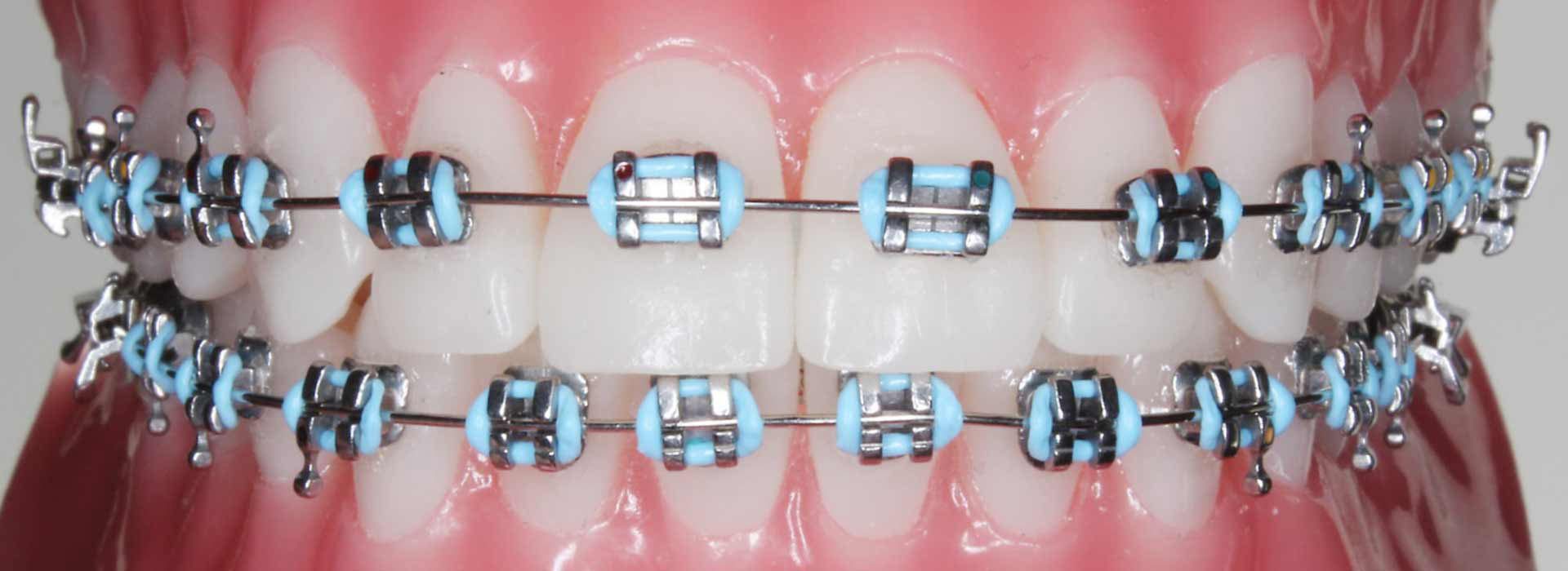 standard metal braces