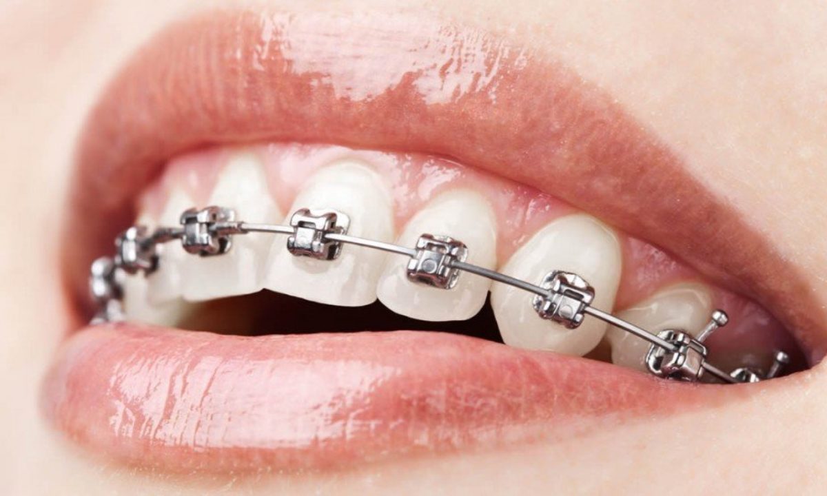 Ask Your New Caney Dentist: Should I Get Metal or Clear Braces?