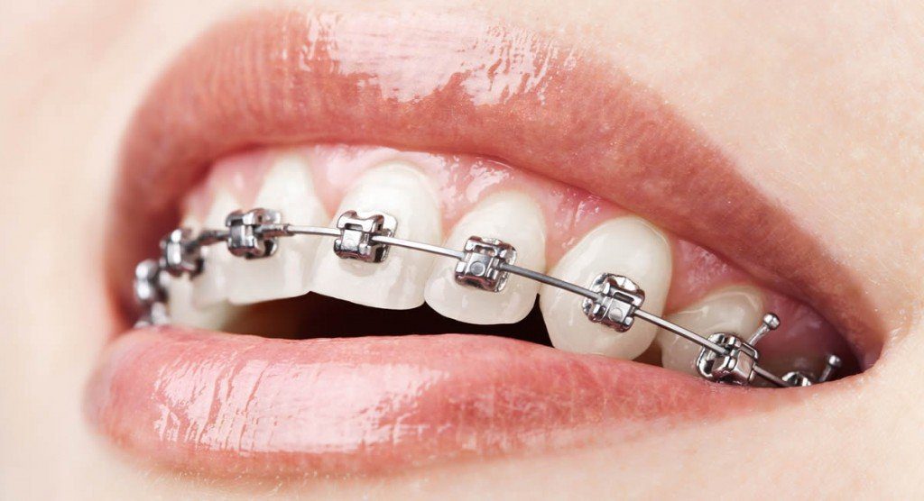 Braces with metal clip 