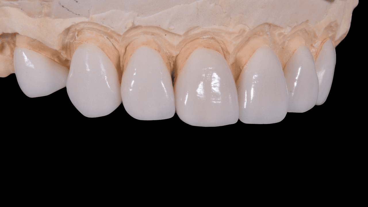 3D Printed Teeth Offer Many Benefits for Dental Patients