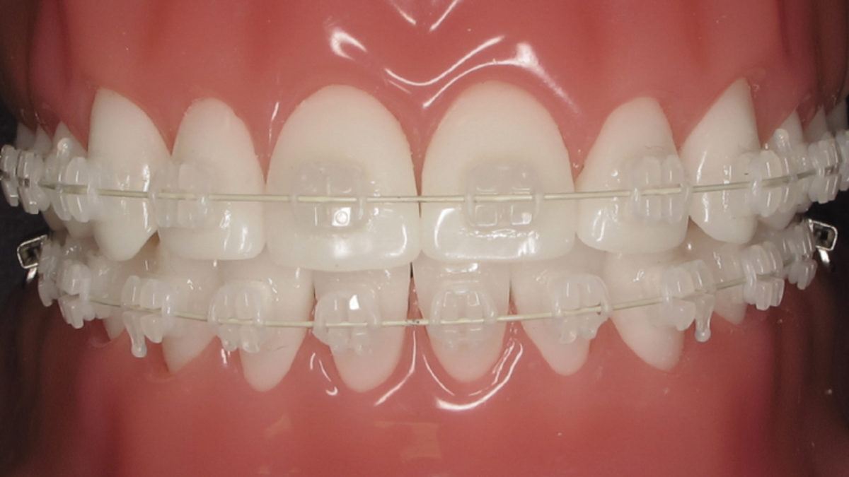 Pros &amp; Cons of Getting Ceramic Braces - Barrie Dentist