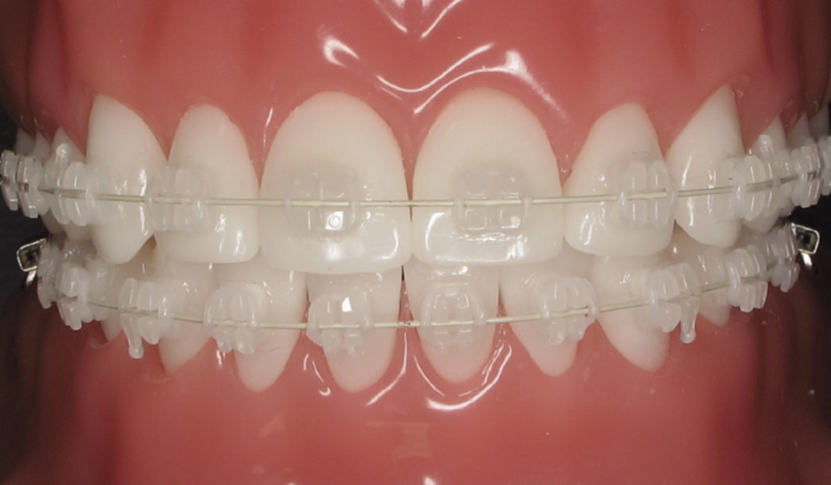 The Pros and Cons of Ceramic Braces - Orange Coast Orthodontics