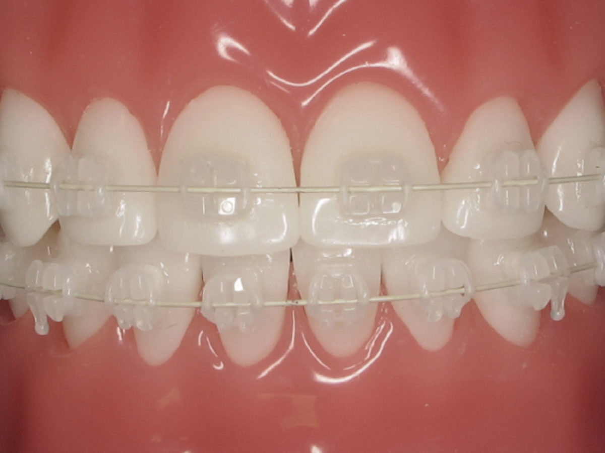 Metal Braces: Pros and Cons - Smiles Orthodontics