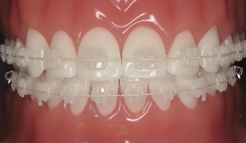 5 điều cần lưu ý khi sử dụng niềng răng rõ ràng
