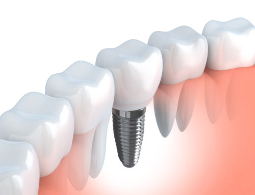 Missing or Damaged Teeth? All on Four, Single Implants & More