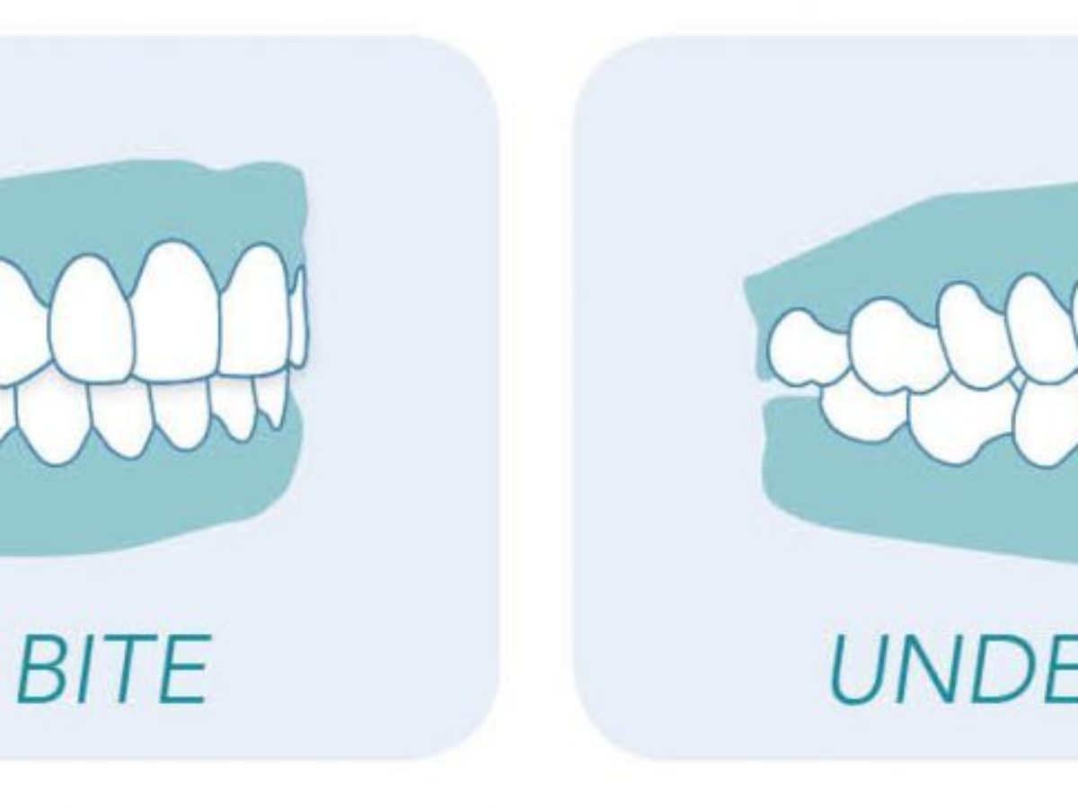 How Do BRACES FIX Overbites?, Overbite Before and After Braces