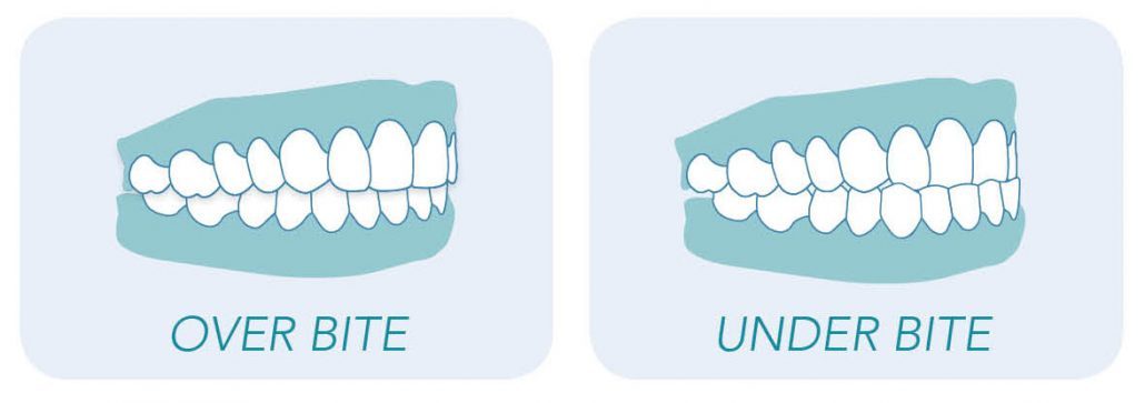 Underbite teeth