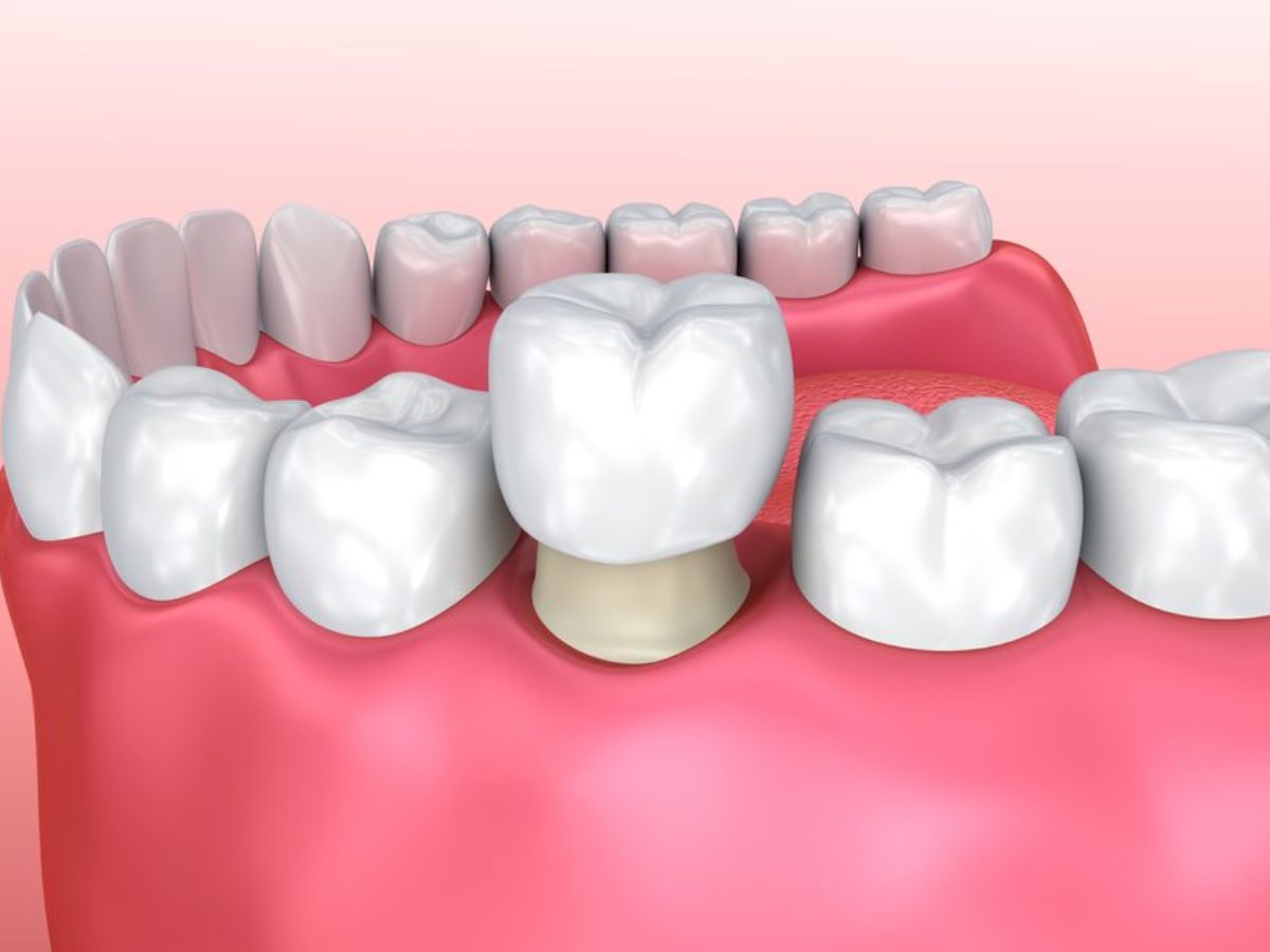 Signs That Your Dental Crown Is A Perfect Fit