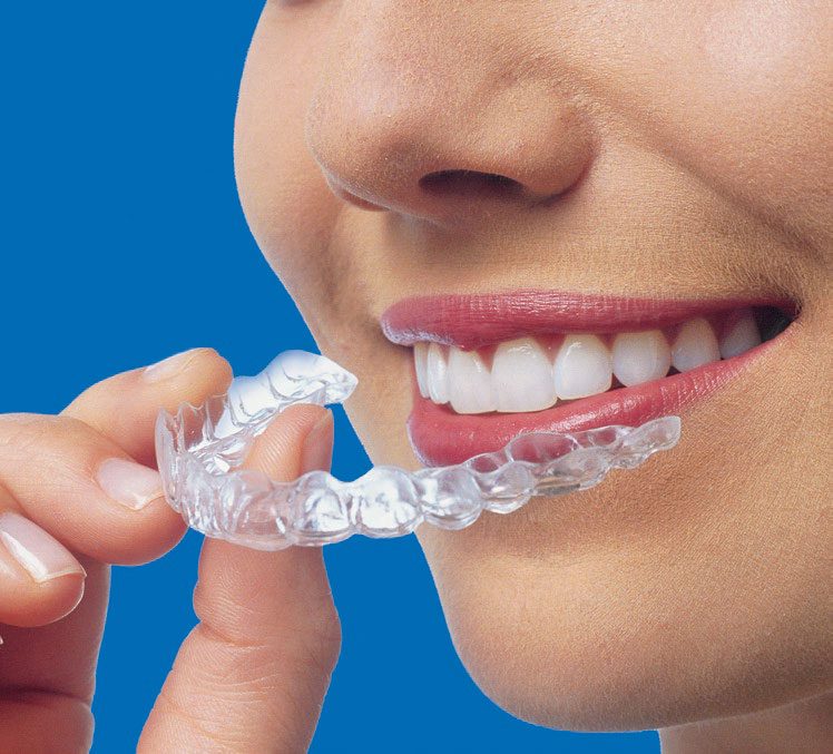 Understanding the Benefits and Drawbacks of Invisalign.