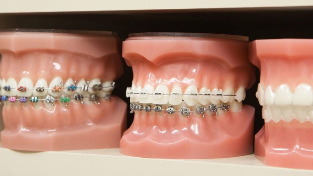 Why are invisalign braces so popular?