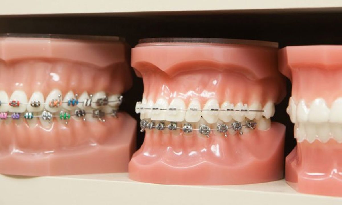 The Different Types of Braces - Westermeier Martin Dental Care