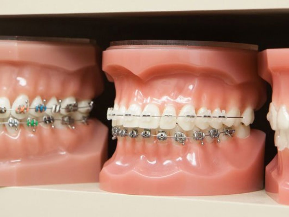 Pros and Cons of Invisalign vs. Braces - Montreal, QC - Dr. Roni