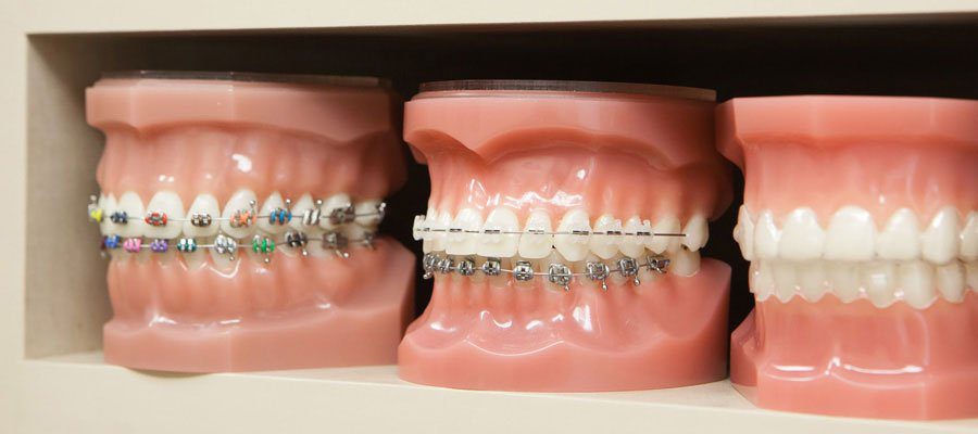 Types of Dental Braces - How & Who Makes Them?