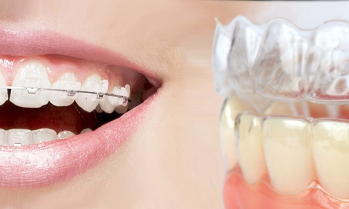 Invisalign vs. Braces: Which Is Better? – Forbes Health