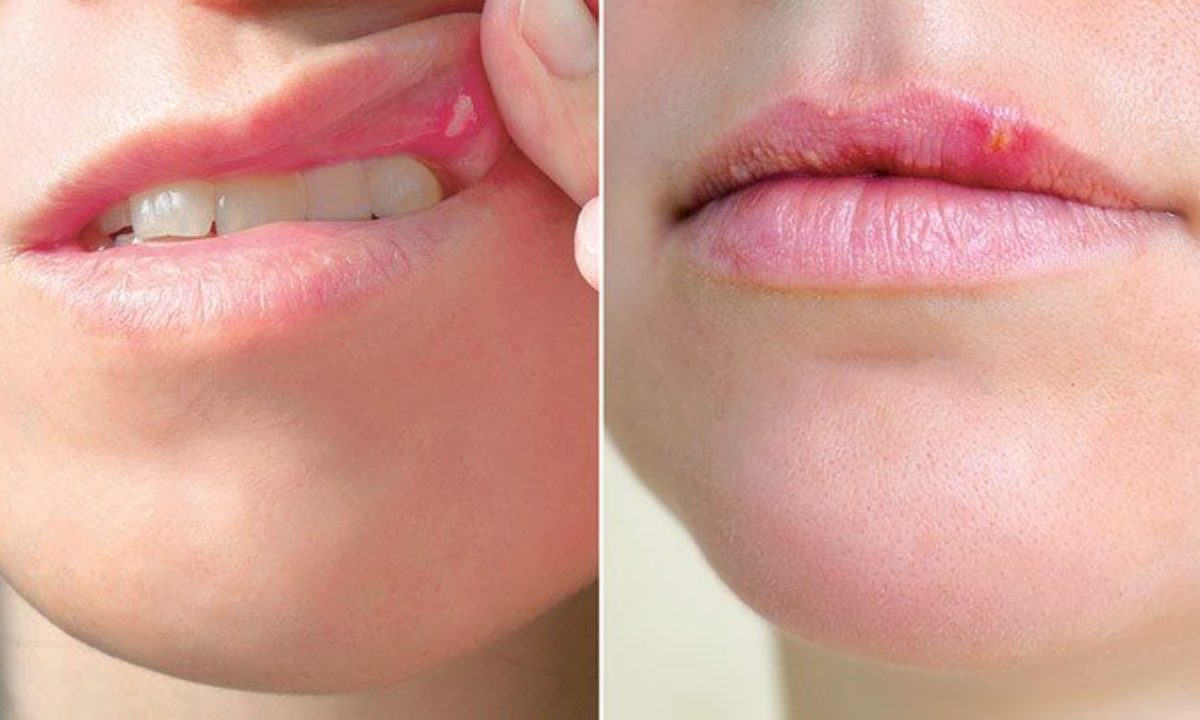 Rid to of natural herpes get ways Home Remedies