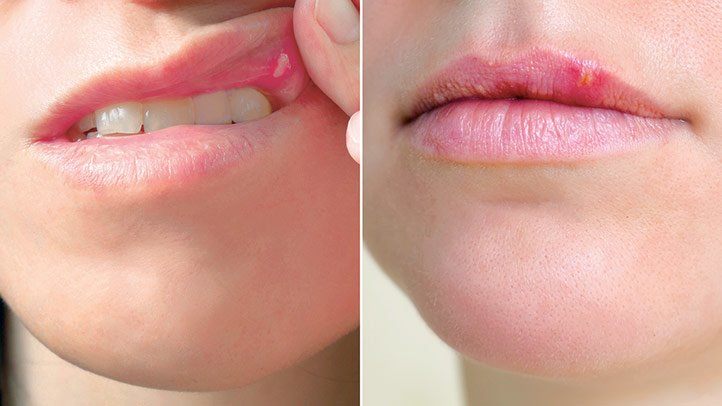 cold sore inside mouth