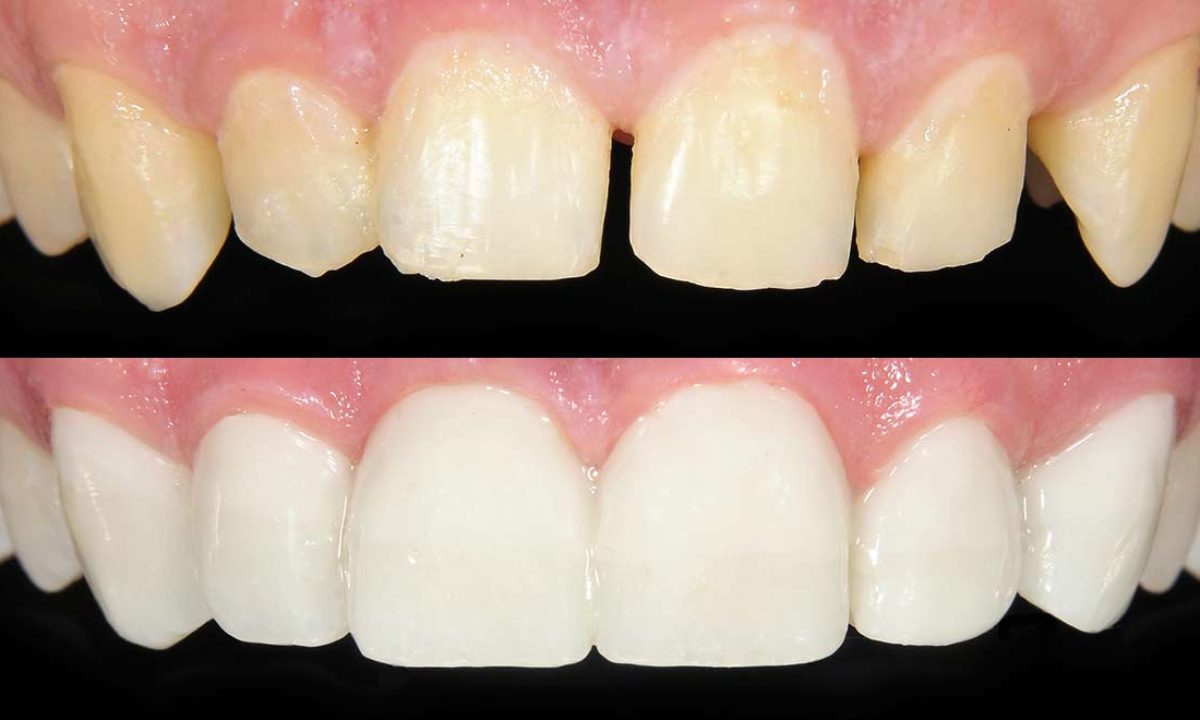 Dental Bonding Can Repair the Look of Teeth - Denville Dental