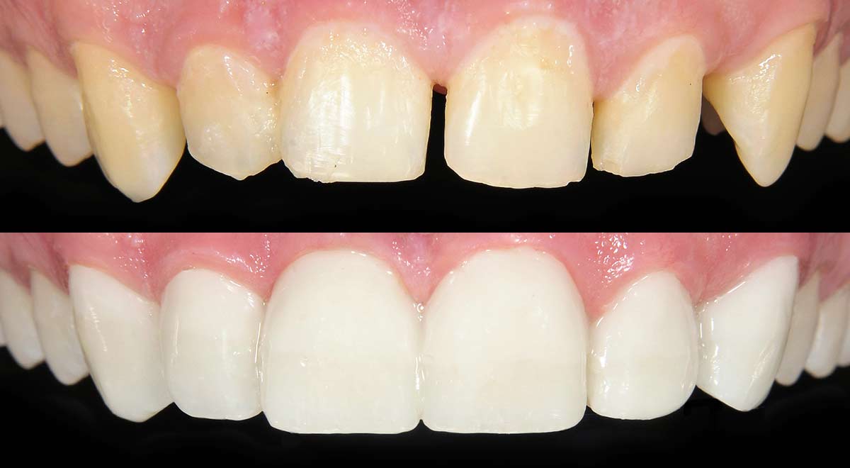 How Dental Bonding Repairs Damaged & Chipped Teeth