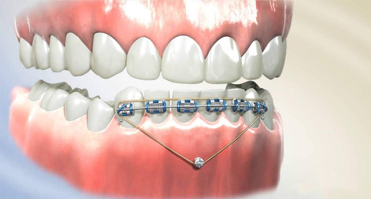 Temporary Anchorage Devices (TAD) Can Help Braces Procedures