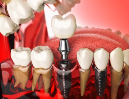 Tooth Implant Options & Costs