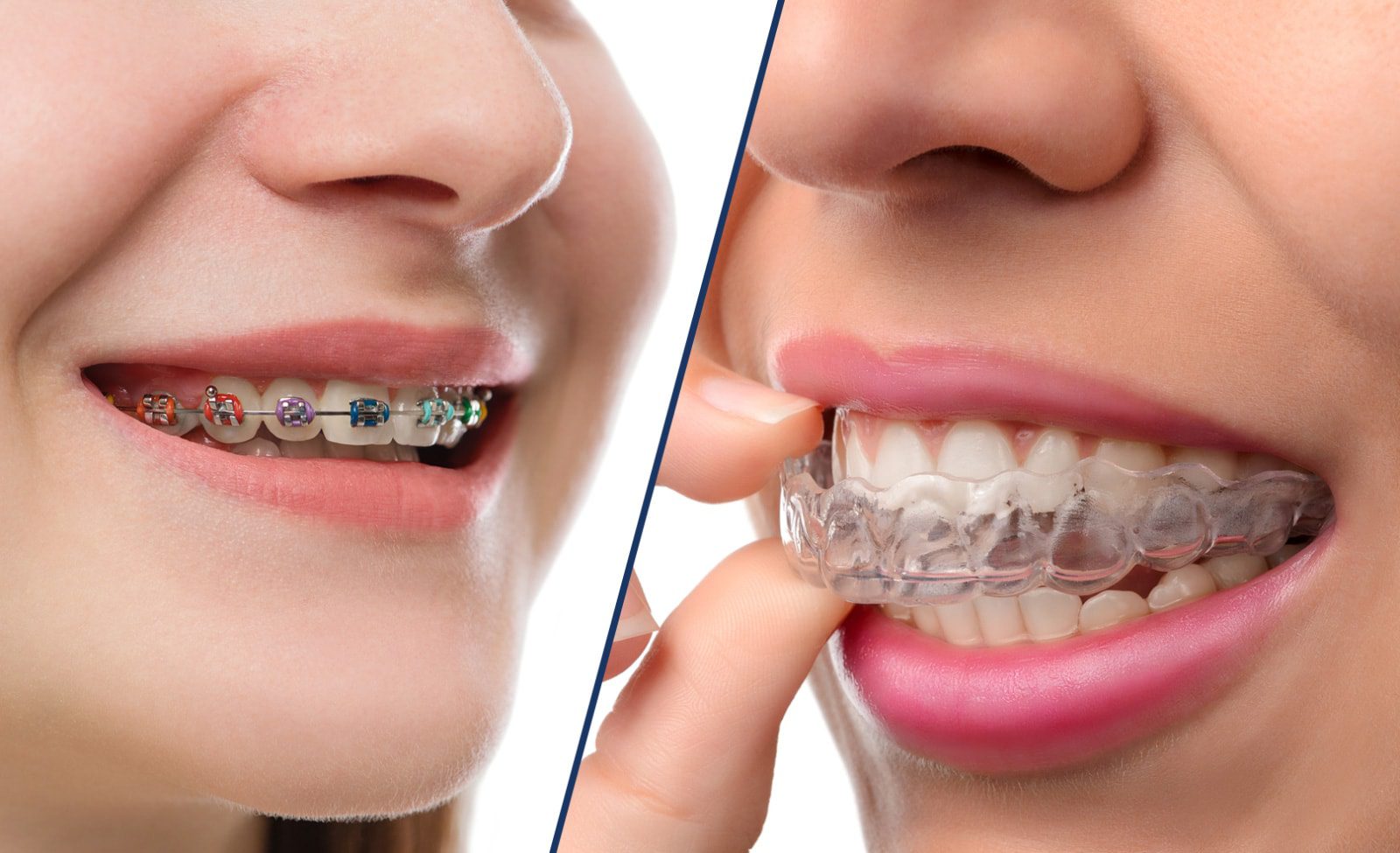 Transparent Teeth Braces VS Traditional Braces