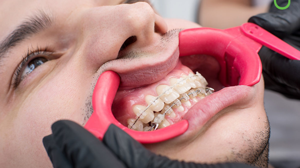 Ceramic braces: Pros and cons, cost, and results