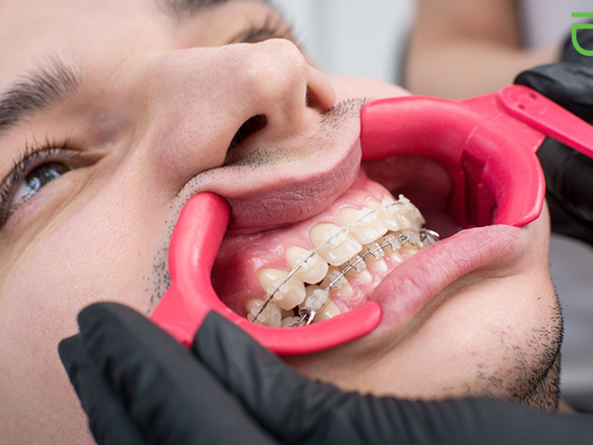 Come up with radioactivity cinema Ceramic Braces Considerations | Clear Braces Insights