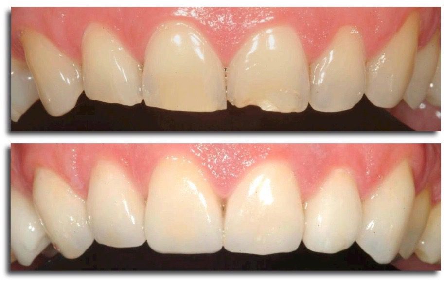Find Out if Dental Veneers are the Right Choice for You
