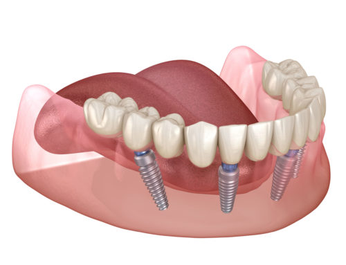 Comparing All-on-4 and All-on-6 Dental Implant Procedures