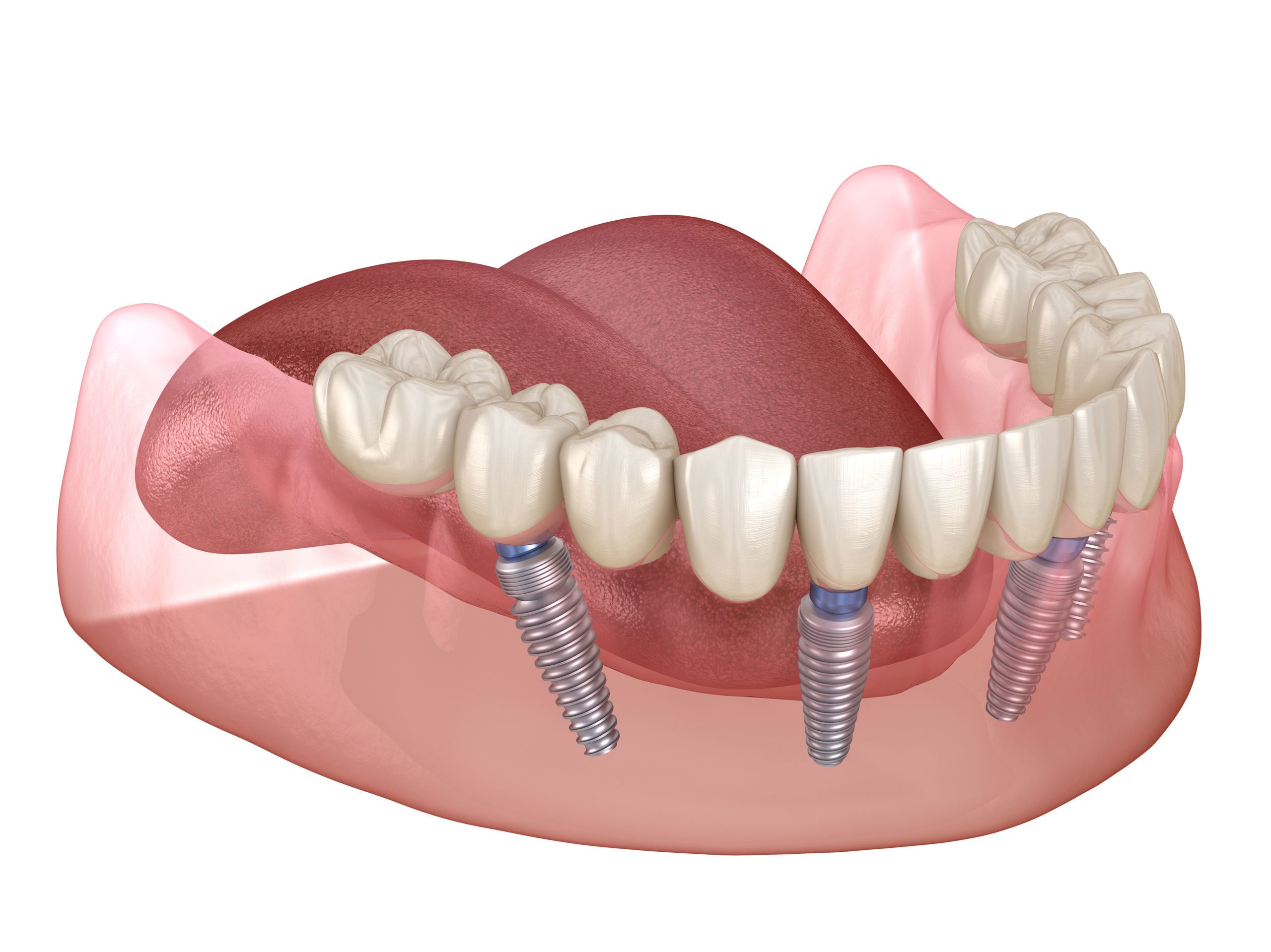 All-On-4 Dental Implants Cost Montreal  