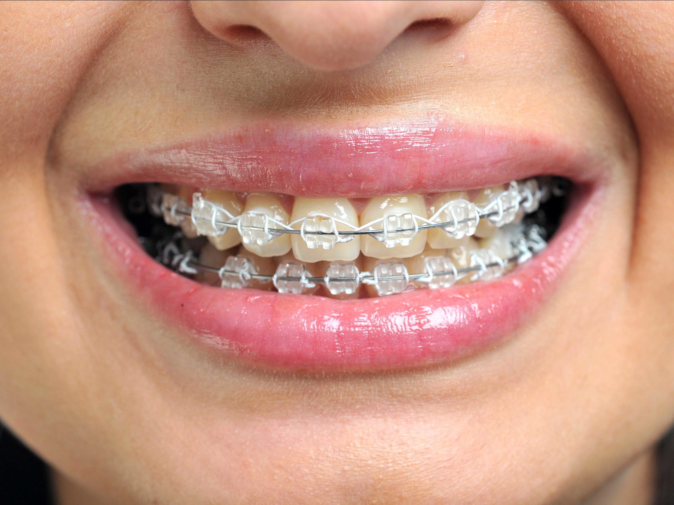 Orthodontics Invisalign Ceramic Fast Braces Metal