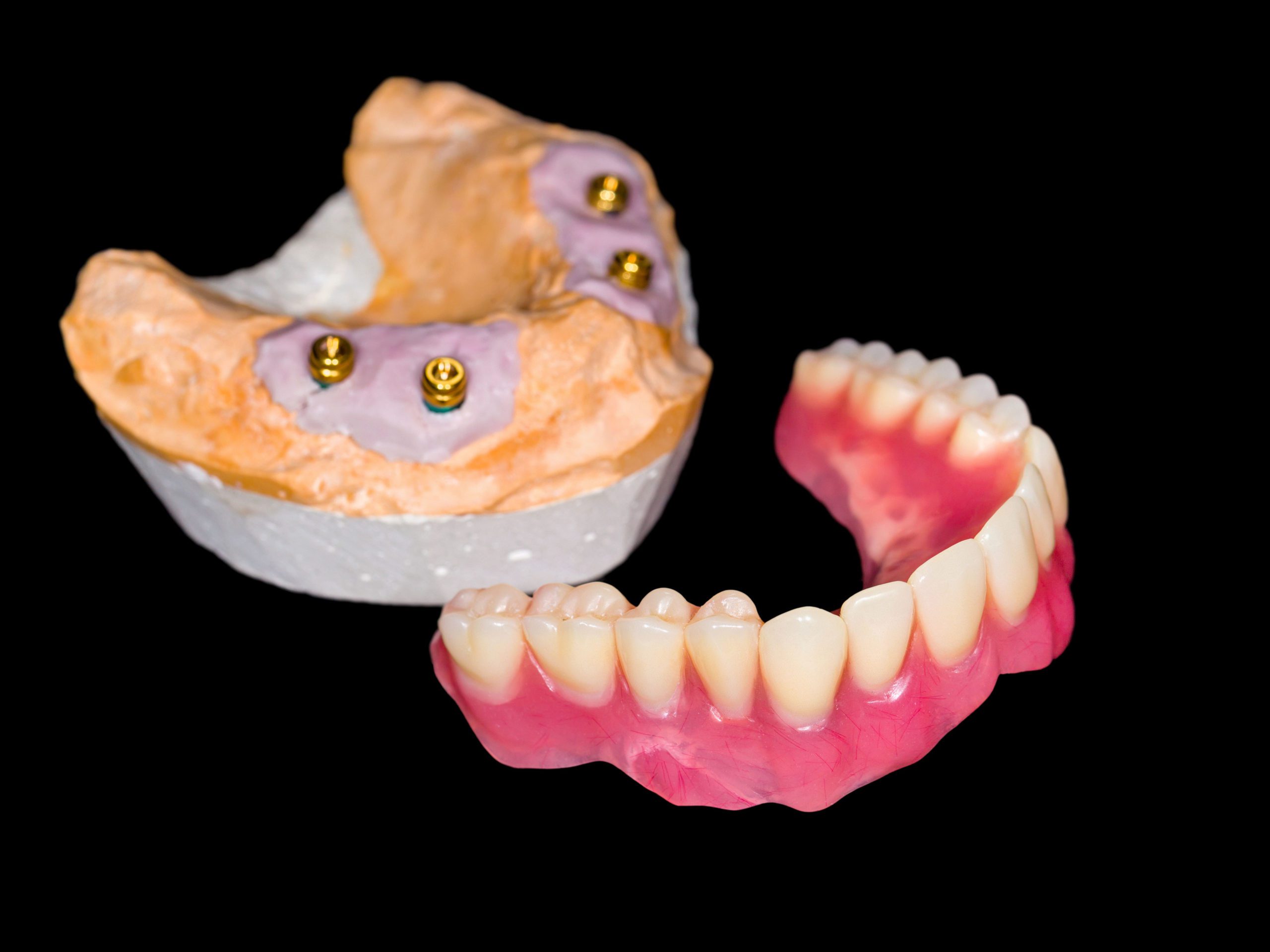 All-on-4 dental implant supported denture