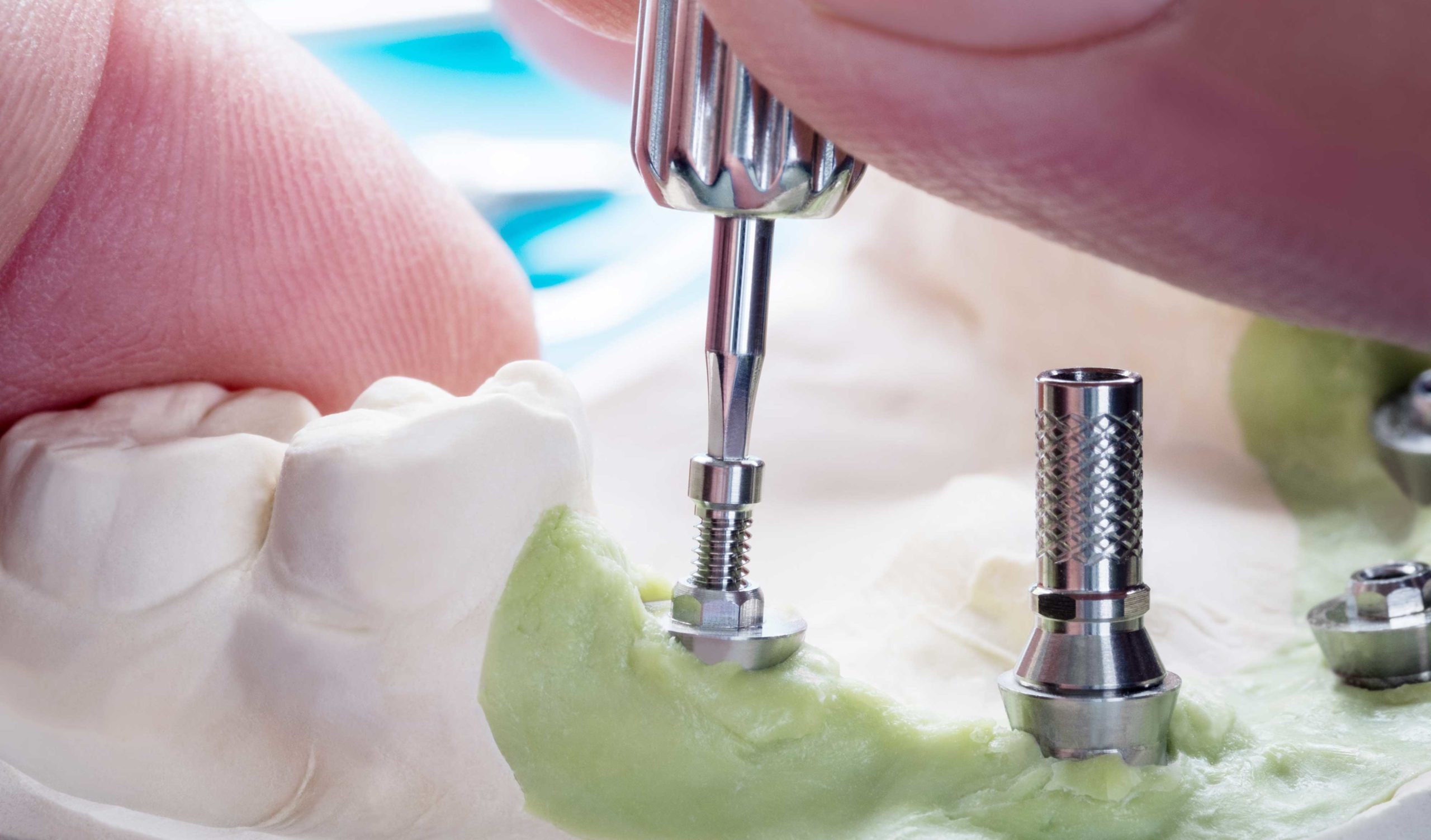 Dental Implants Single Implants & Whole Mouth Restorations