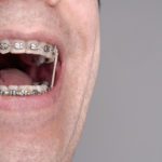 The Average Cost of Braces - Ries Orthodontics