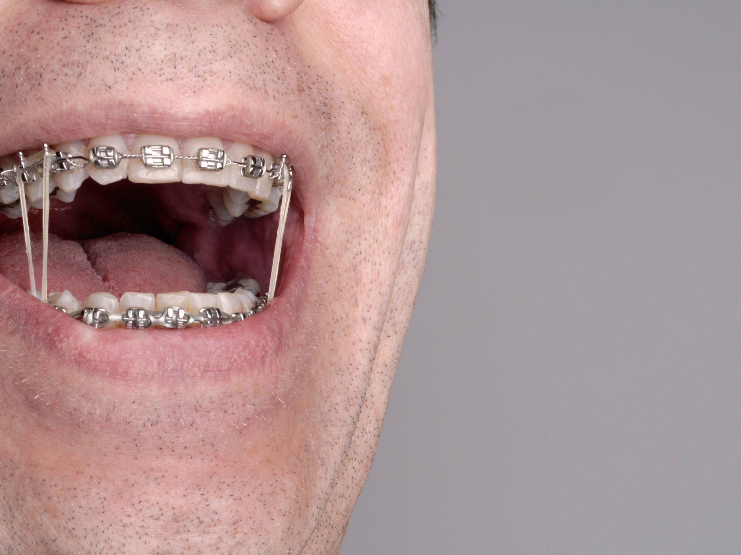 Orthodontics Braces Invisalign Ceramic And Metal