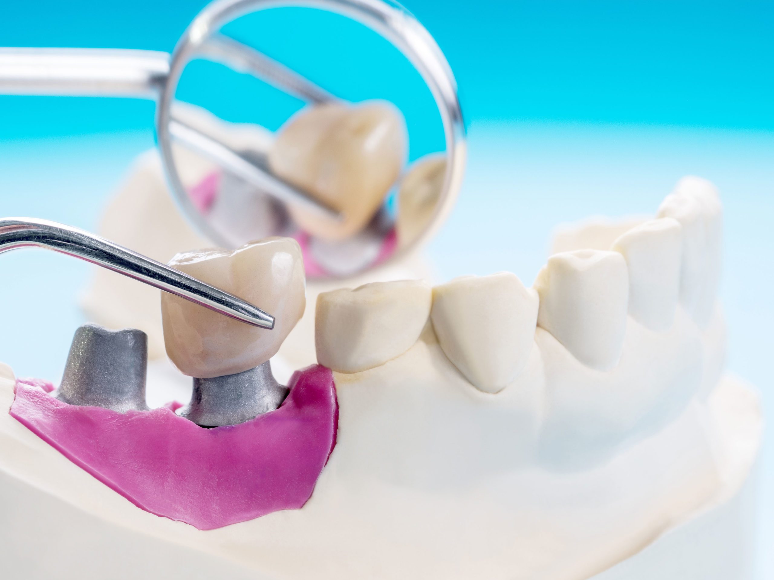 Three-Implant-Options-Left-Column