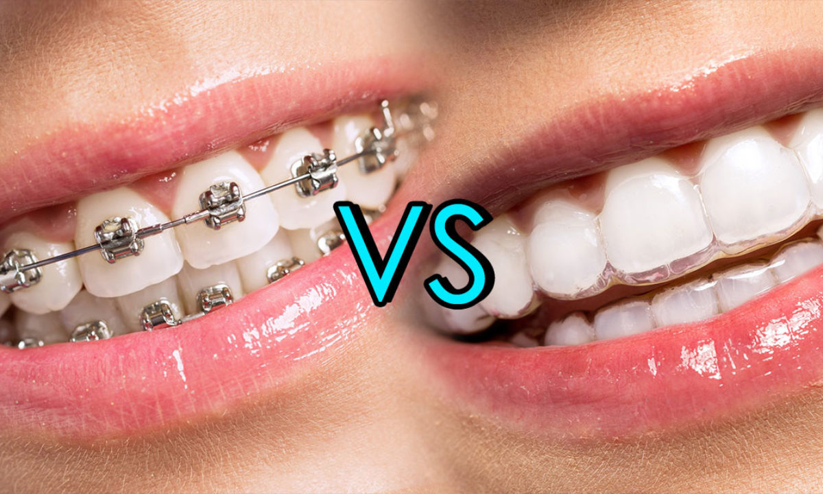 Invisalign or Braces for Lasting and Perfect Teeth