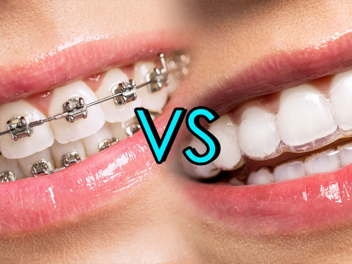 Metal Braces vs. Invisalign - Bali Implant Aesthetic (BIA) Dental