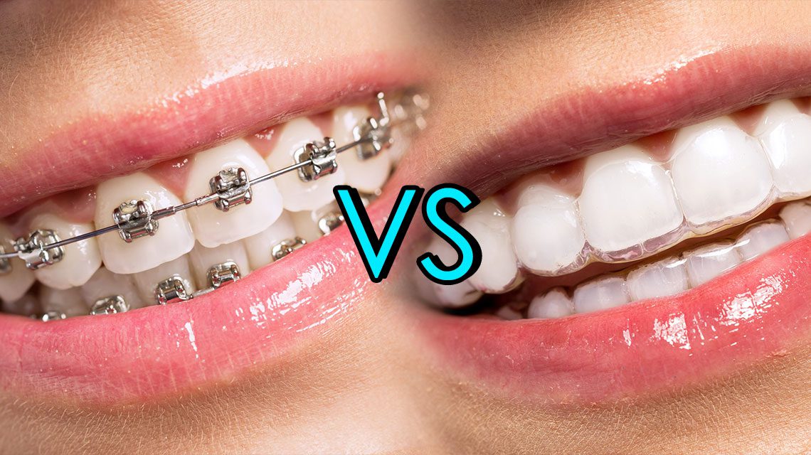 Metal Braces or Invisalign Aligners - Which Should You Choose?