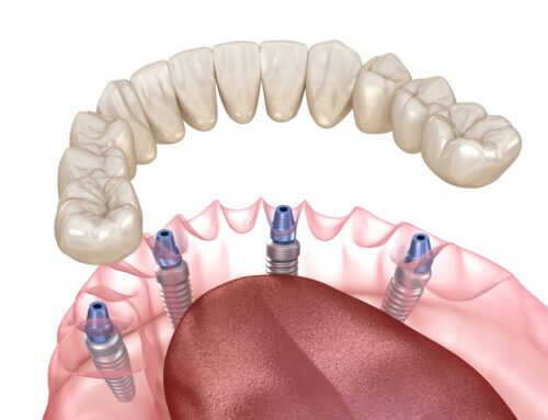 All-on-4 -vs- Dentures