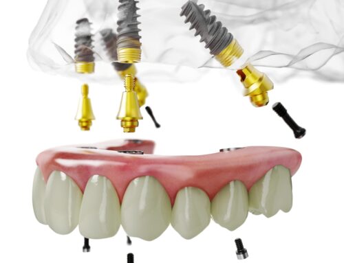 Dental Implants in One Day