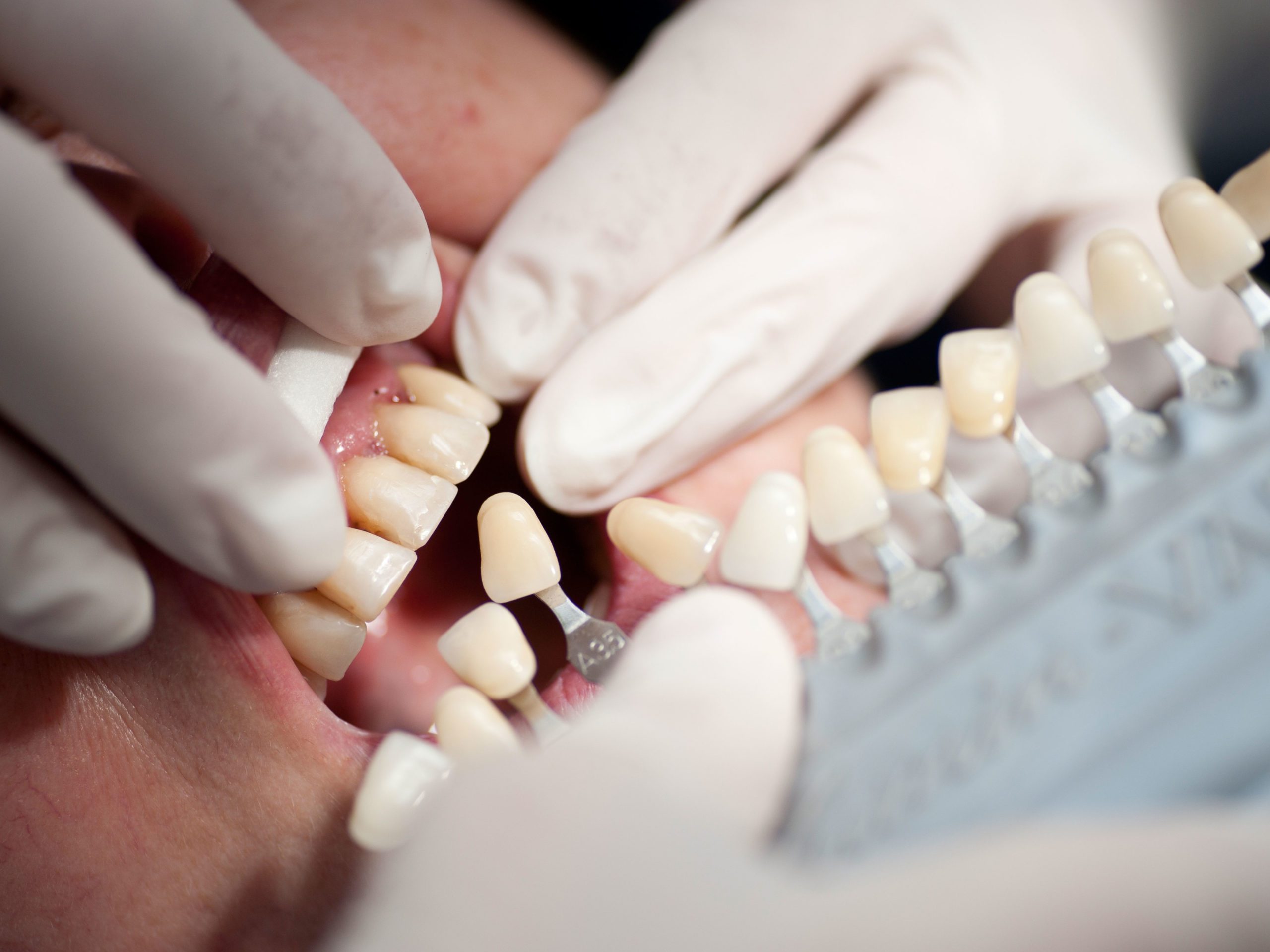 Dental-Bonding-#2