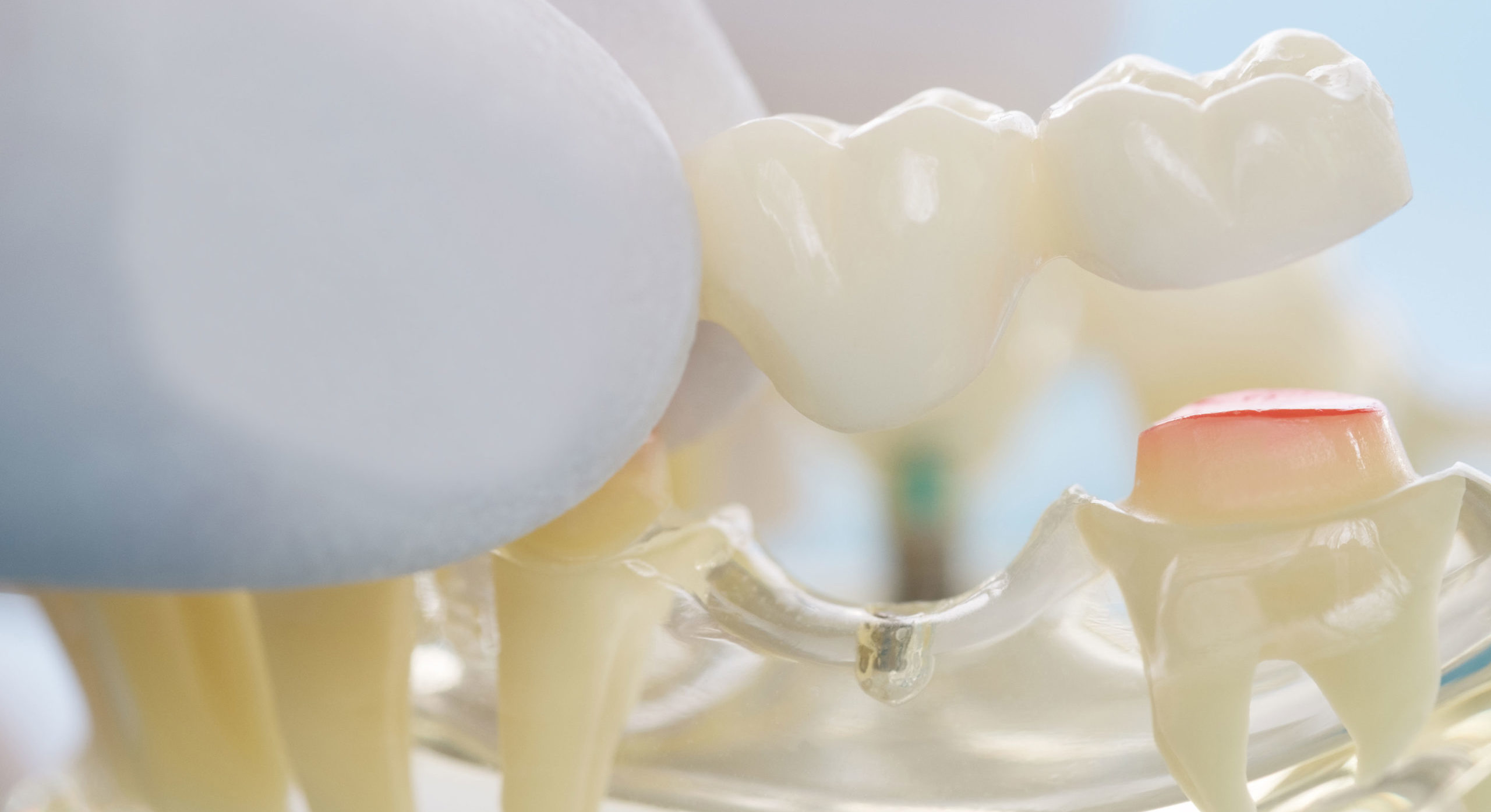 What are Dental Crowns and Bridges?